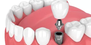 Permanent Solution for Missing Teeth: Dental Implants