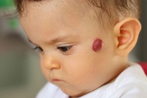 Hemangioma Treatment