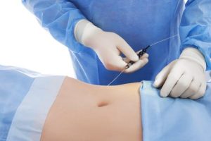 Liposuction Treatment