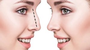 Rhinoplasty