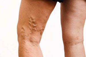Varicose Vein Treatment